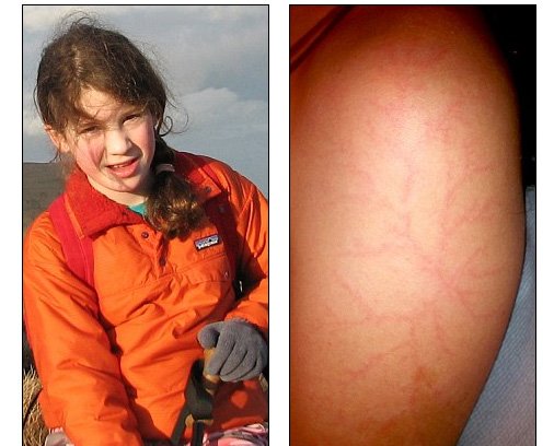 Erin Moran hit by lightning scar harry potter